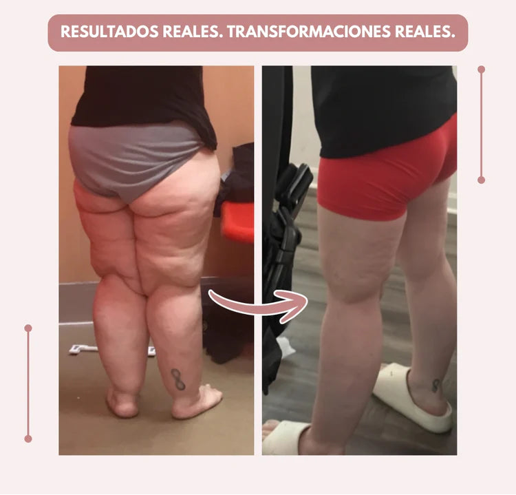 Curvella 3D Legging – Despídete del dolor y la fatiga del lipoedema de forma natural
