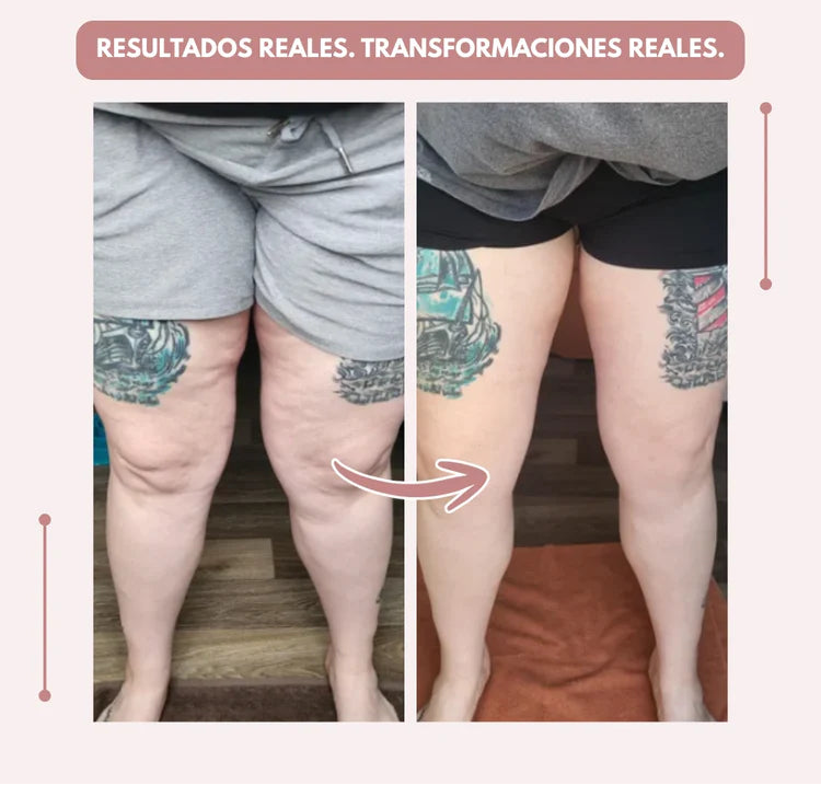 Curvella 3D Legging – Despídete del dolor y la fatiga del lipoedema de forma natural